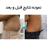 دستگاه هایفو اولترافورمر Black 13D سه هندپیس - Image 9