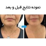 دستگاه هایفو اولترافورمر Black 13D سه هندپیس - Image 8